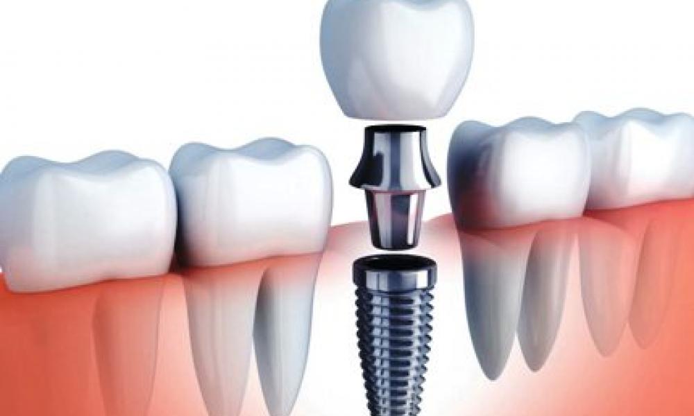 En España se colocan entre 1,2 y 1,4 millones de implantes al año 