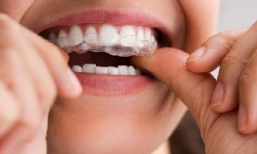 Los Colegios de Dentistas denuncian ante la Agencia Española del Medicamento a varias empresas por vender alineadores dentales directamente al público